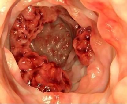 Tổng quan về ung thư ống hậu môn